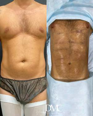 Мужская липоскульптура с липосакцией всех проблемных зон с тщательной прорисовкой мышечного рисунка пресса и груди сразу после операции
