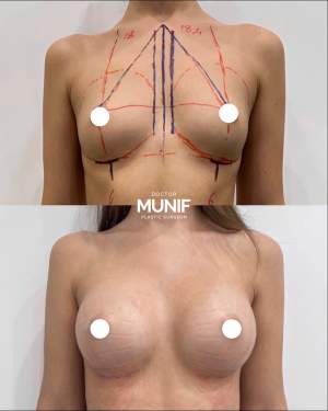 Результат увеличения груди имплантами Motiva: фото до и 2 недели после, на плановом осмотре