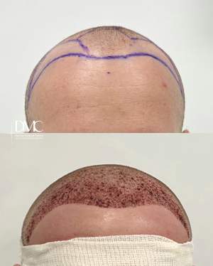 Результат трансплантации волос в лобно-височную зону до и на 2-е сутки после. Работа доктора Альбины Дахировны Тебуевой