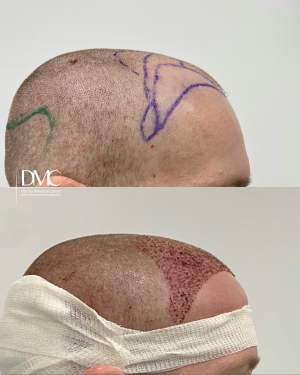 Результат трансплантации волос в лобно-височную зону до и на 2-е сутки после. Работа доктора Альбины Дахировны Тебуевой
