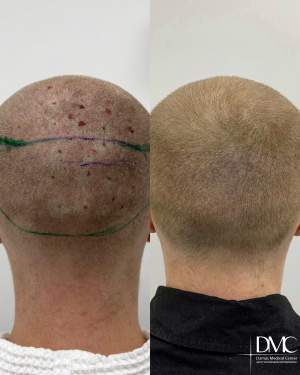 Демонстрация донорской зоны после трансплантации волос в лобно височную зону до на 10 сутки после. Работа доктора Альбины Дахировны Тебуевой