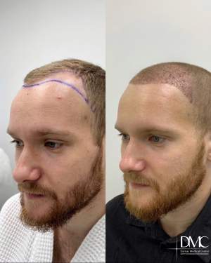 Результат трансплантации волос в лобно-височную зону: фото  до и на 10 сутки после. Работа доктора Альбины Дахировны Тебуевой