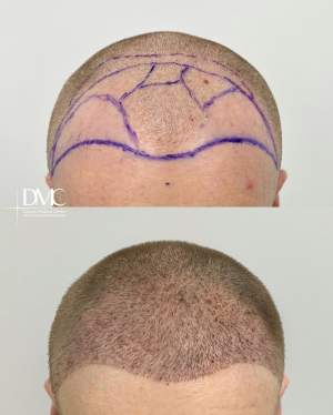 Результат трансплантации волос в лобно-височную зону: фото  до и на 10 сутки после. Работа доктора Альбины Дахировны Тебуевой