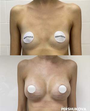 Увеличение груди эргономичными имплантами Motiva: до и на 7 сутки после операции. Работа Анны Петровны Першуковой