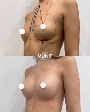 Увеличение груди имплантами с коррекцией формы и объема: до и после полной ребалитации. Работа доктора Мунифа Хальдун