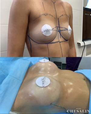 Увеличение груди анатомическими имплантами: до и сразу после операции. Работа Ивана Павловича Чесалина