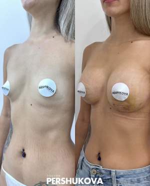 Увеличение груди эргономичными имплантами Motiva: до и на 5 сутки после операции. Работа Анны Петровны Першуковой
