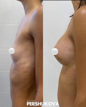 Увеличение груди имплантами с коррекцией формы и объема: до и через 14 дней после. Работа Амжада Аль-Юсеф