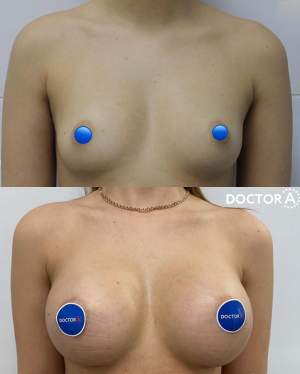 Увеличение груди имплантами с коррекцией формы и объема: до и после полной ребалитации. Работа Амжада Аль-Юсеф