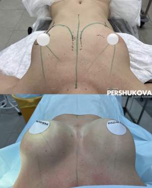 Увеличение груди эргономичными имплантами Motiva: до и на сразу после операции. Работа Анны Петровны Першуковой