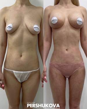 Увеличение груди эргономичными имплантами Motiva + липоскульптура тела на аппарате Vaser: до и на 12 сутки после операции. Работа Анны Петровны Першуковой