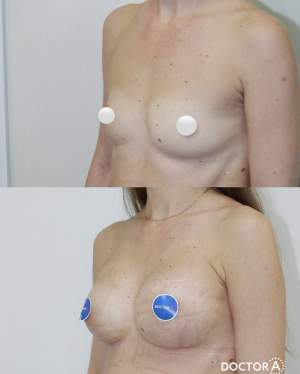 Увеличение груди имплантами с коррекцией формы и объема: до и через 10 дней после. Работа Амжада Аль-Юсеф