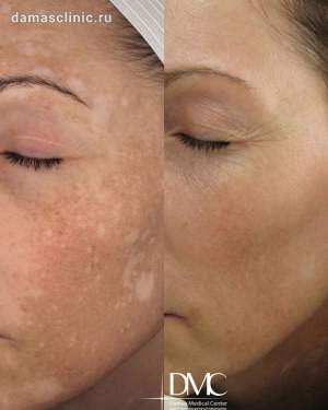 BBL - омоложение лица до и после  Работа врача дерматокосметолога Розы Гидалтиеаны