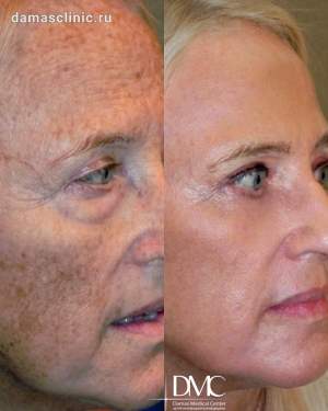 BBL - омоложение лица + круговая пластика век: до и после поэтапно  Работа пластического хирурга, дерматокосметолога Лалиты Кориговой