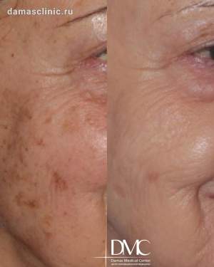 BBL - омоложение лица до и после  Работа врача дерматокосметолога Розы Гидалтиеаны