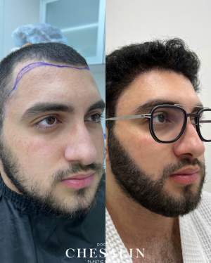 Результат трансплантации волос в лобно-височную зону + зону бороды: фото до и 11 месяцев после. Работа доктора Ивана Павловича Чесалина