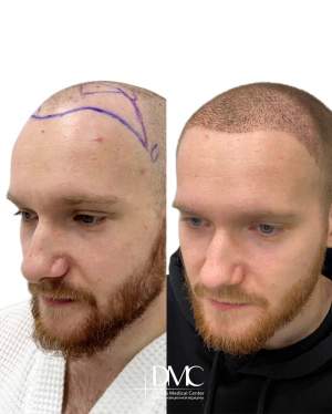 Результат трансплантации волос в лобно-височную зону : фото до и на 20-е сутки после. Работа доктора Альбины Дахировны Тебуевой