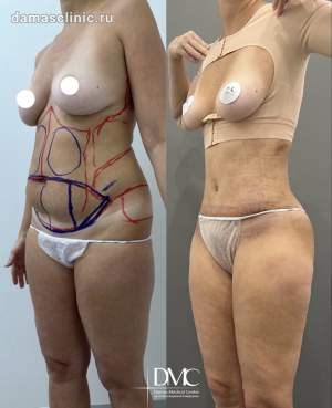 Комплексная пластика тела: липосакция живота, боков, спины + абдоминопластика с пластикой пупка. Работа пластического хирурга Лалиты Кориговой