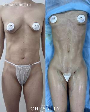 Результат сужения талии по методу  доктора Кудзаева: фото до и после