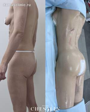 Результат сужения талии по методу  доктора Кудзаева: фото до и после