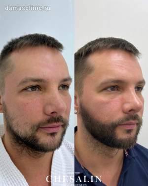 Пересадка в зону бороды : до и через 4 месяца после. Работа доктора Ивана Павловича Чесалина