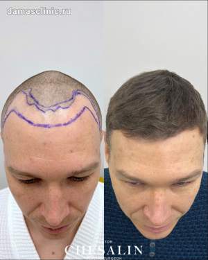 Результат мужской пересадки волос в височно-лобную зону. Работа доктора Ивана Павловича Чесалина