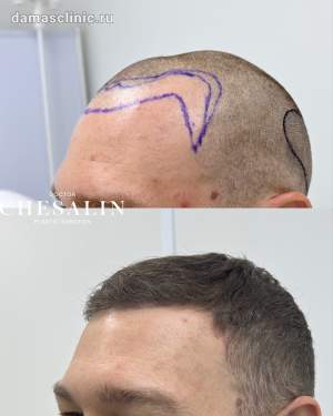 Результат мужской пересадки волос в височно-лобную зону. Работа доктора Ивана Павловича Чесалина