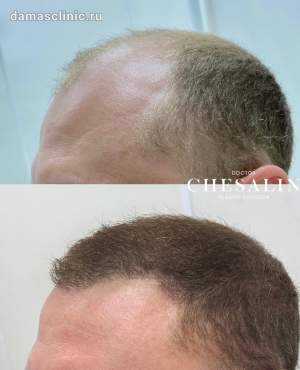 Результат мужской пересадки волос в височно-лобную зону и зону макушки в период первичной реабилитации. Работа доктора Ивана Павловича Чесалина