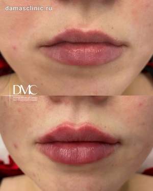 Контурная пластика губ: до и сразу после процедуры