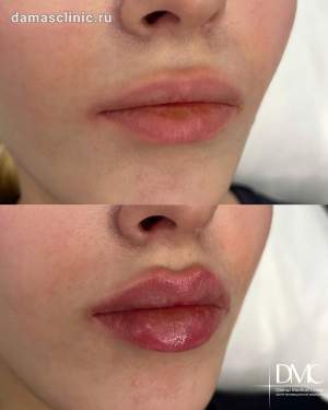 Контурная пластика губ: до и сразу после процедуры