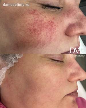 Промежуточный результат лечения сосудистой сетки на лице: до и после