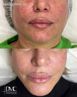Лечение сосудов на лице: до и после