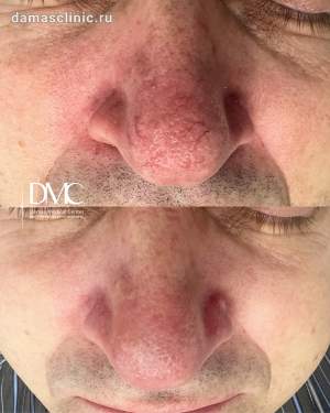 Лечение сосудов на носу: до и после