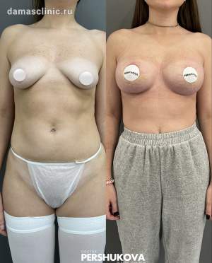 Увеличение груди с одномоментной подтяжкой по ареоле: до и через 1 месяц после. Работа Анны Петровны Першуковой