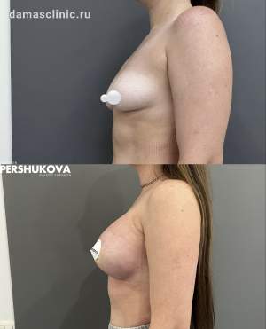 Увеличение груди с одномоментной подтяжкой по ареоле: до и через 1 месяц после. Работа Анны Петровны Першуковой