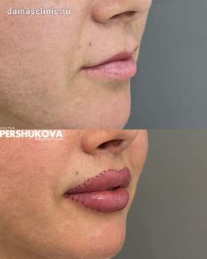 Пластика губ Кессельринг на 2-е сутки после операции. Плановый осмотр. Работа Анны Петровны Першуковой