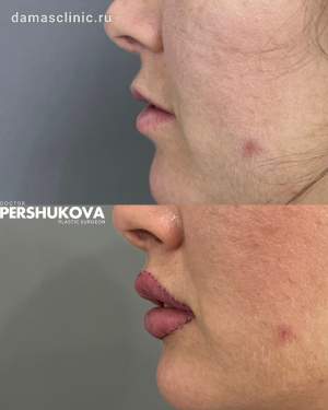Пластика губ Кессельринг на 2-е сутки после операции. Плановый осмотр. Работа Анны Петровны Першуковой