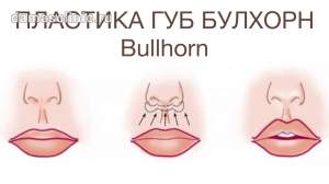 Пластика губ Булхорн (Bullhorn)