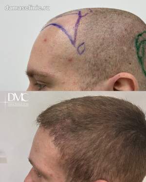 Мужская пересадка волос: до и через через 6 месяцев после трансплантации в височно-лобную зону, в период первичной реабилитации. Работа Альбины Дахировны Тебуевой