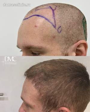 Мужская пересадка волос: до и через через 6 месяцев после трансплантации в височно-лобную зону, в период первичной реабилитации. Работа Альбины Дахировны Тебуевой