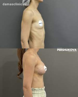 Увеличение формы и объема груди имплантами: до и на 6-е сутки после операции, на плановом осмотре. Работа Анны Петровны Першуковой
