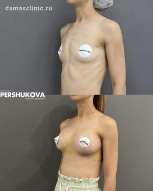 Увеличение формы и объема груди имплантами: до и на 6-е сутки после операции, на плановом осмотре. Работа Анны Петровны Першуковой