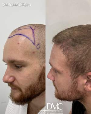 Мужская пересадка волос: до и через и через 6 месяцев после трансплантации в височно-лобную зону, в период первичной реабилитации. Работа доктора Альбины Дахировны Тебуевой