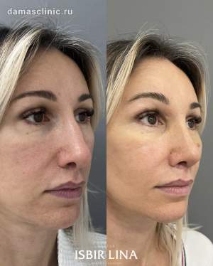 Результат пластики носа с толстой кожей: до и через 8 дней после операции. Работа Лины Алиевны Исбир