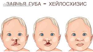 Хейлосхизис – заячья губа у новорожденного