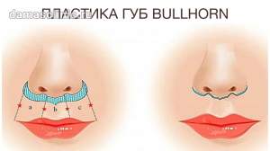 Пластика губ «Булхорн»