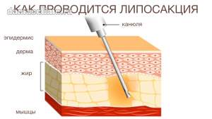 Липосакция проводится без разрезов, через небольшой прокол в коже