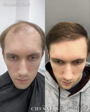 Мужская пересадка волос до и через год после. Работа Ивана Павловича Чесалина