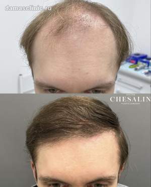 Мужская пересадка волос до и через год после. Работа Ивана Павловича Чесалина