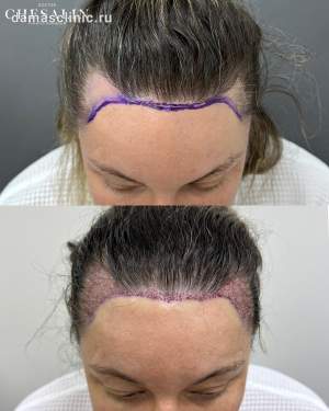 Мужская пересадка волос в височную зону до и сразу после. Работа Ивана Павловича Чесалина